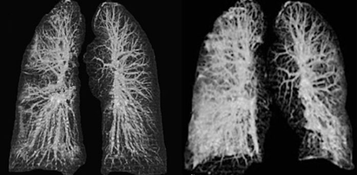 Watch: Shocking Images Of Lungs Affected By Coronavirus ...